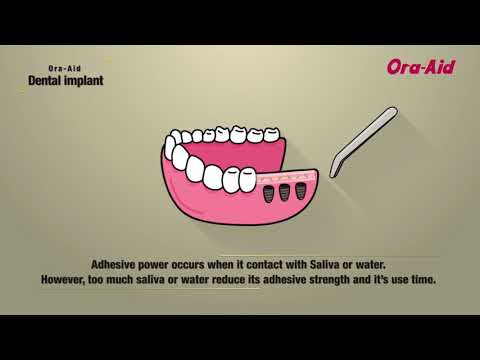 Ora-Aid : Dental Implant