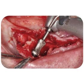 Cut Ridge Safely